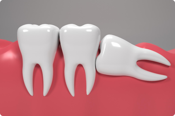 wisdom-tooth-removal